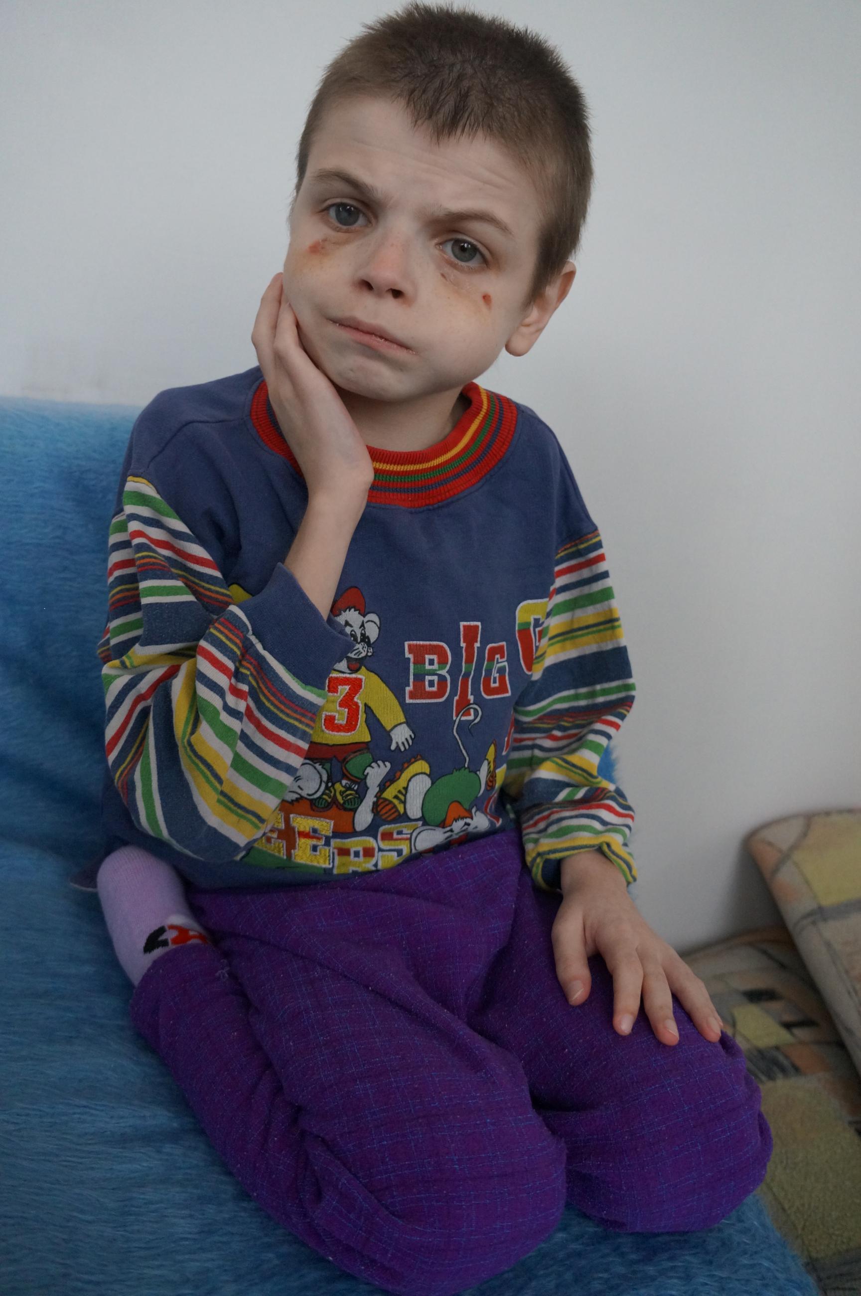 Child with bruised eyes sitting on couch looking into the camera